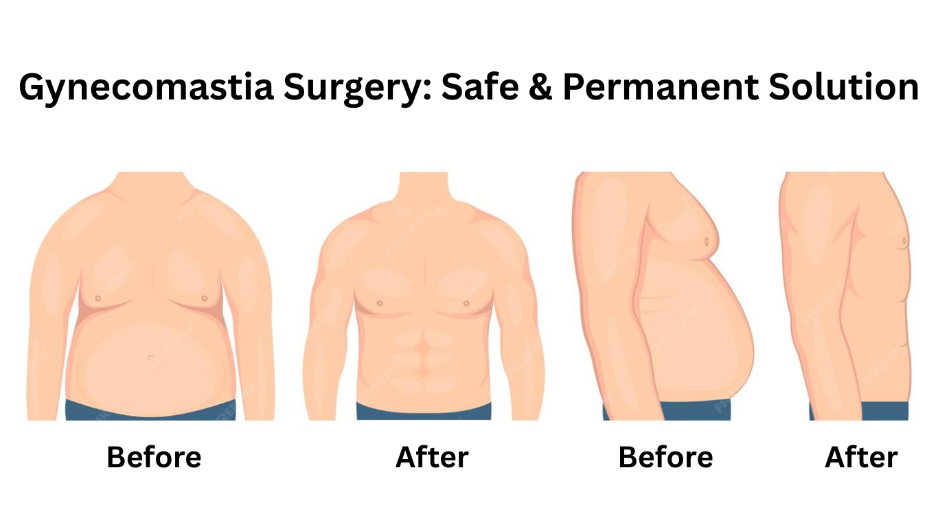Gynecomastia Surgery in Vizag